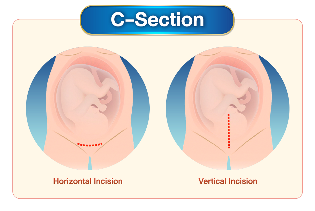  C-section care for caesarean wound (after c-sectioon)