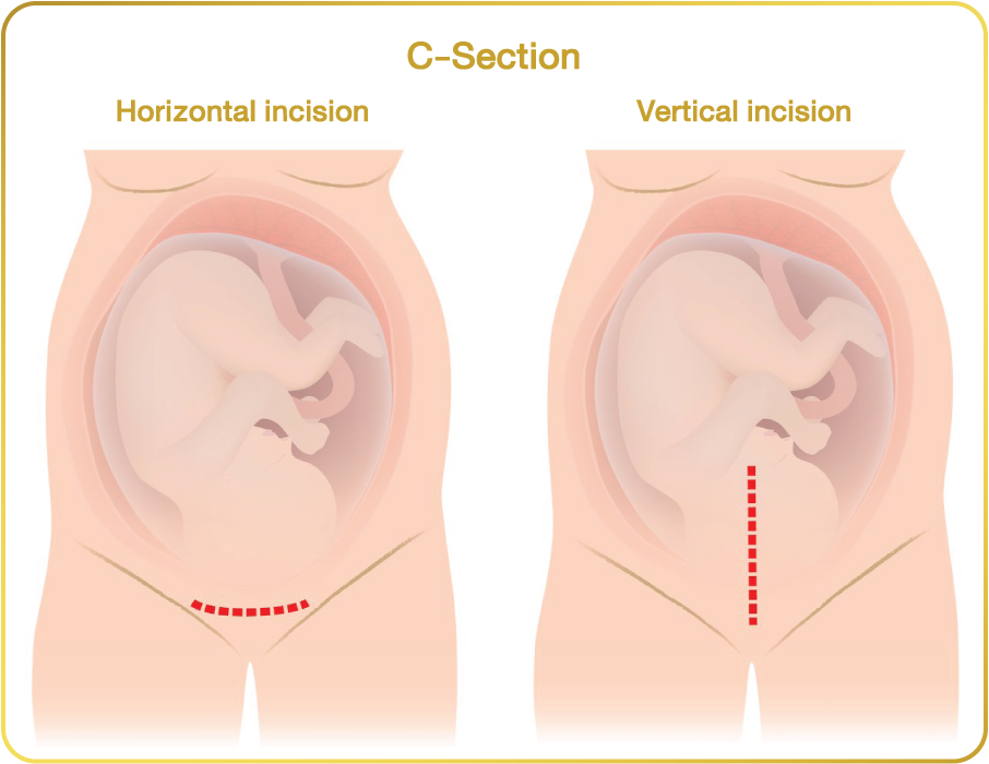 C section how to