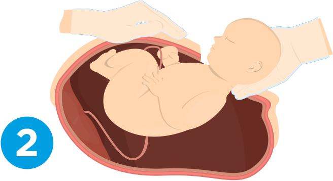 C section process step 2