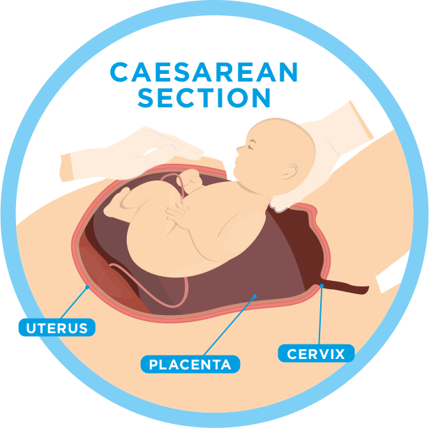 Caesarean section cross section