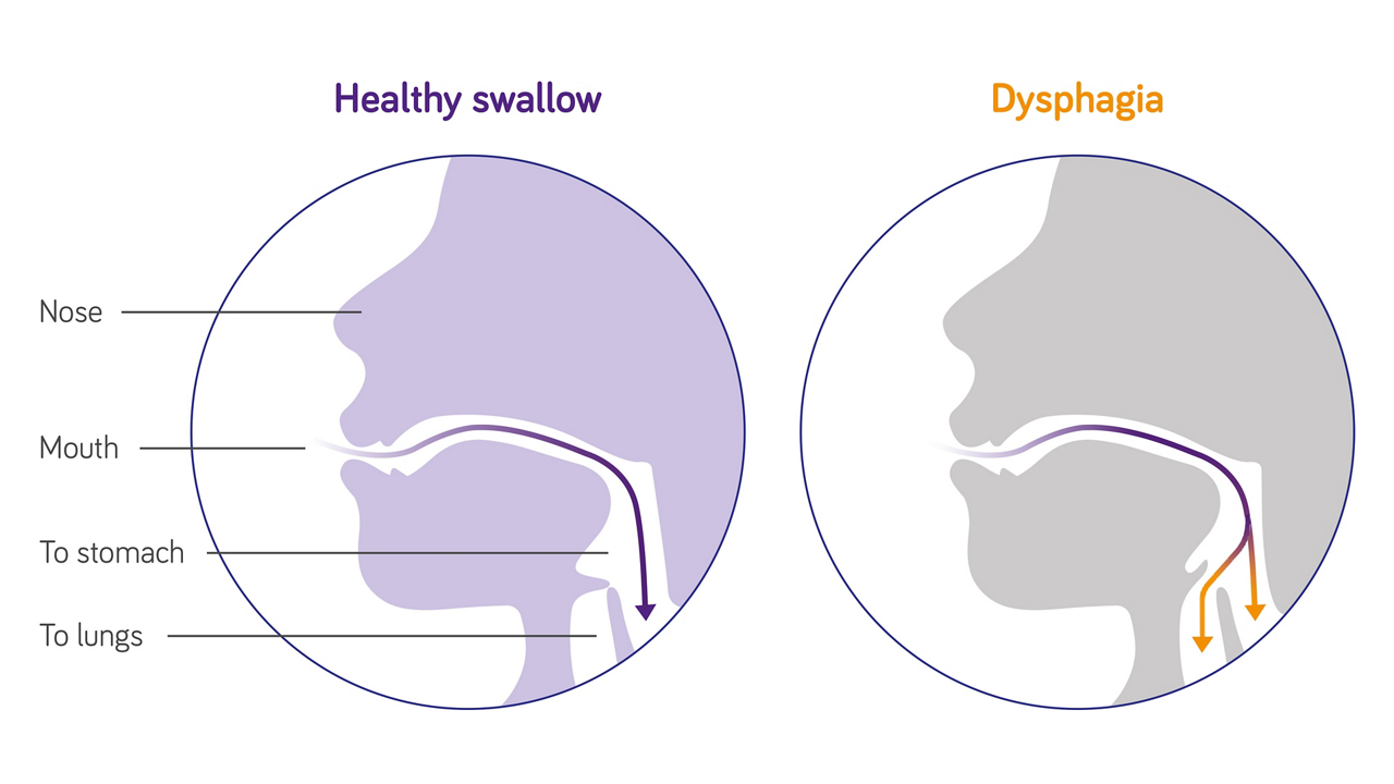 Nutricia stroke dysphagia swallowing difficulties illustration 3840 2160px