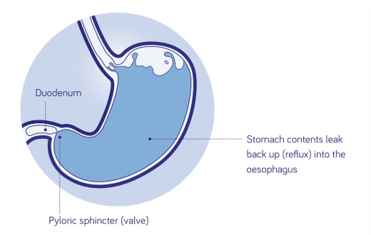 Lower oesophageal sphincter image