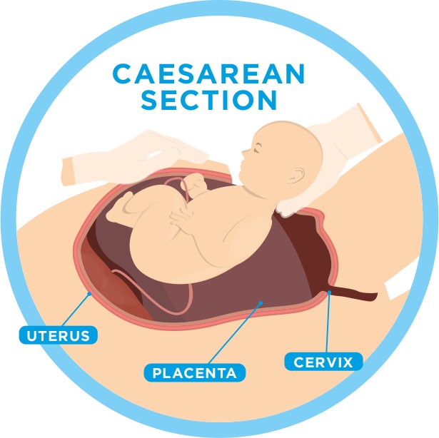 All You Need To Know About CSection Aptamil® Singapore