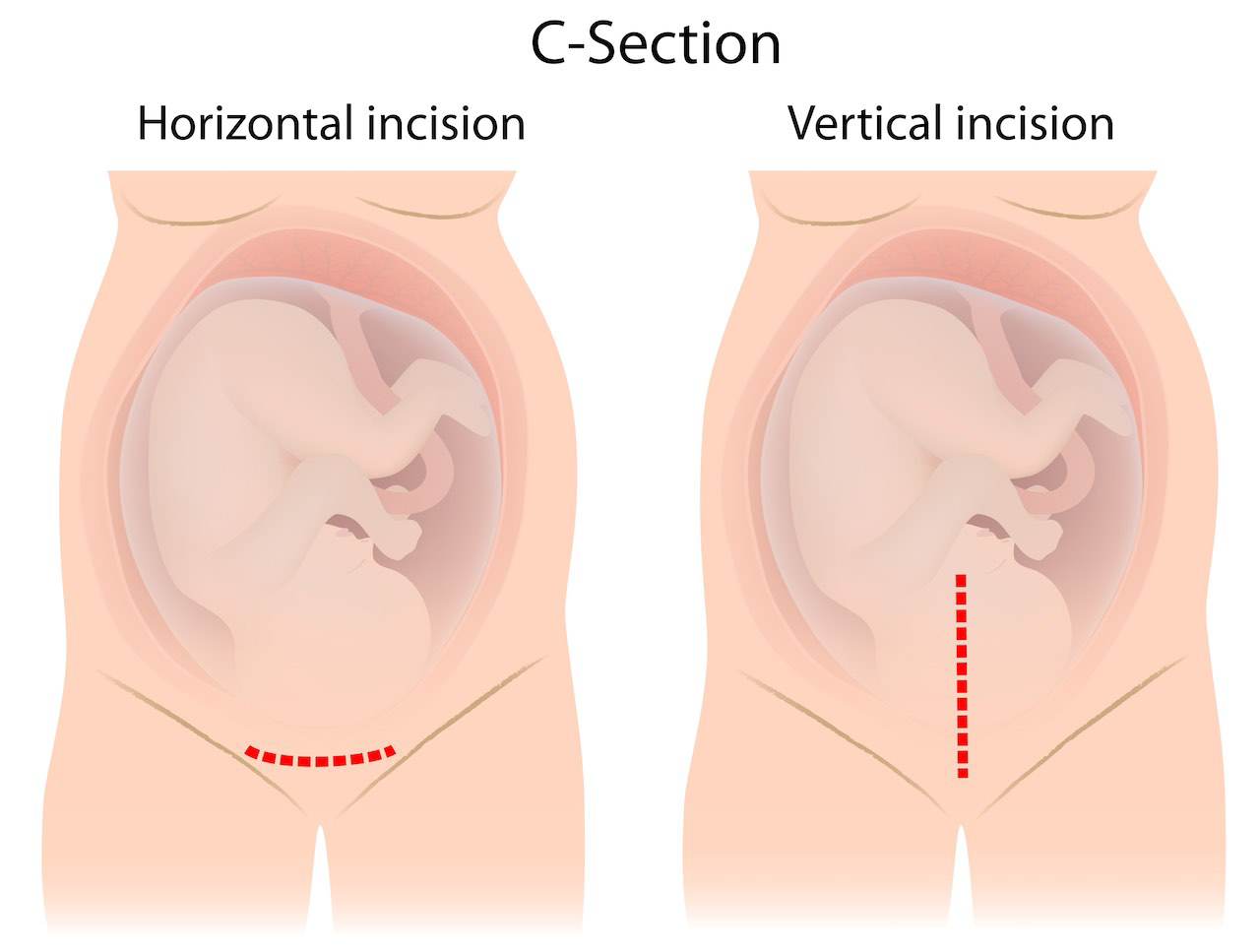 1 месячные после родов. Разрез после кесарева сечения. Корпоральное кесарево сечение. Разрезы при кесаревом сечении.