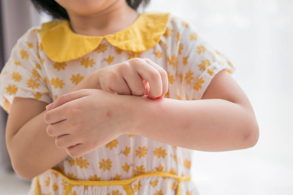 allergic-rash-in-children