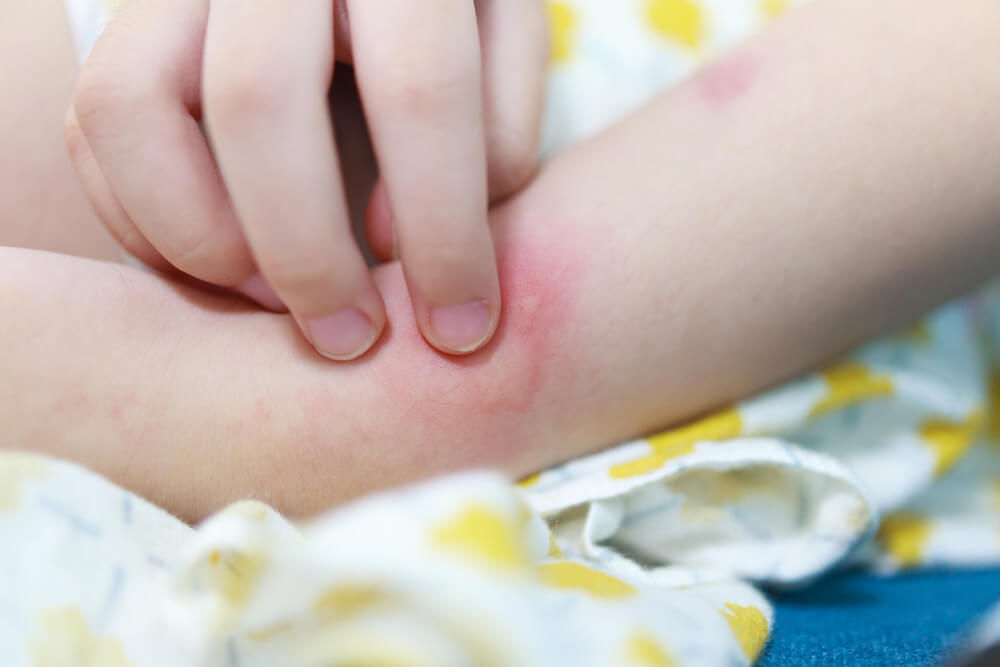 dengue-fever-symptoms-in-childrens