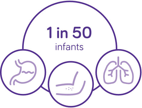 30% prevalence of reflux; regurgitation