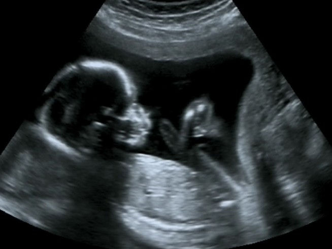 20 week ultrasound