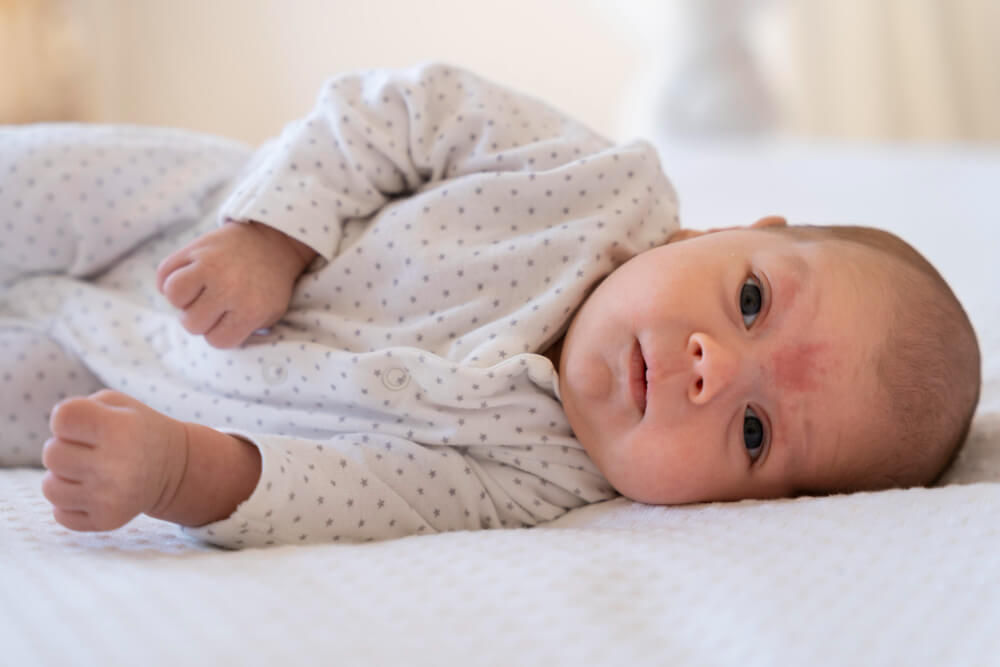 baby-rash
