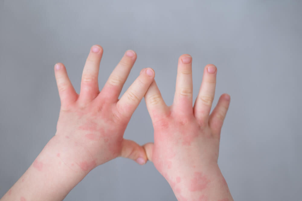 allergic-rash-in-children