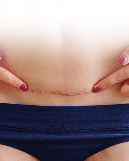 សម្រាលតាមធម្មជាតិ និងវះកាត់ ខុសគ្នាយ៉ាងម៉េច ហើយមួយណាល្អជាង?