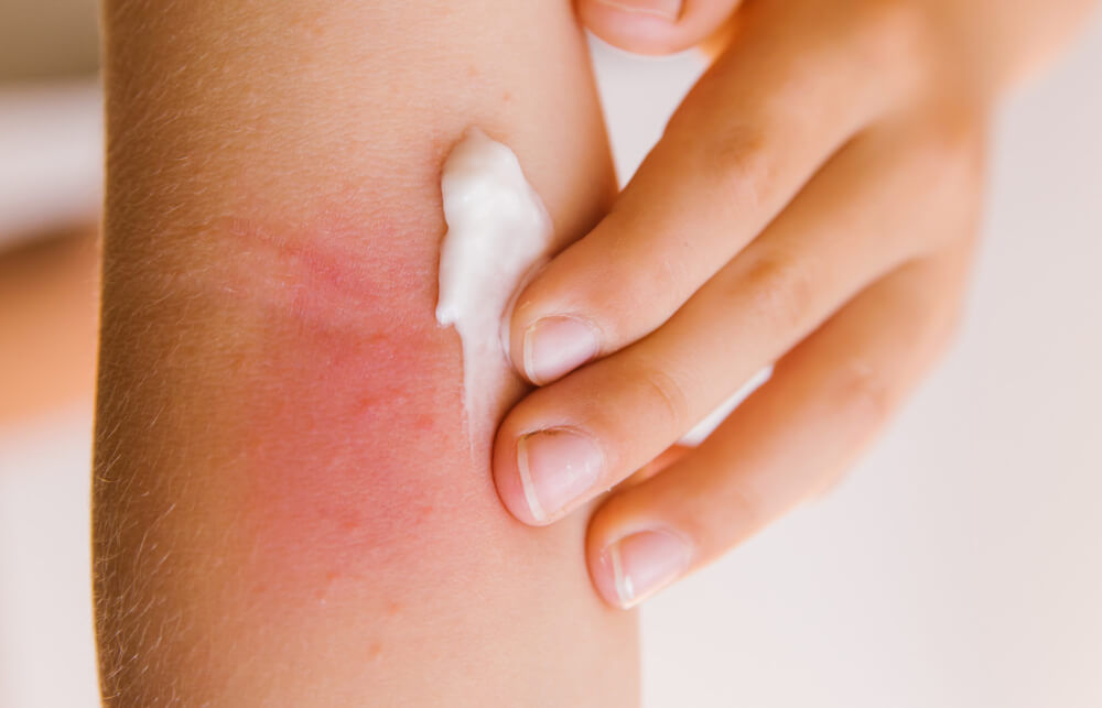 allergic-rash-in-children