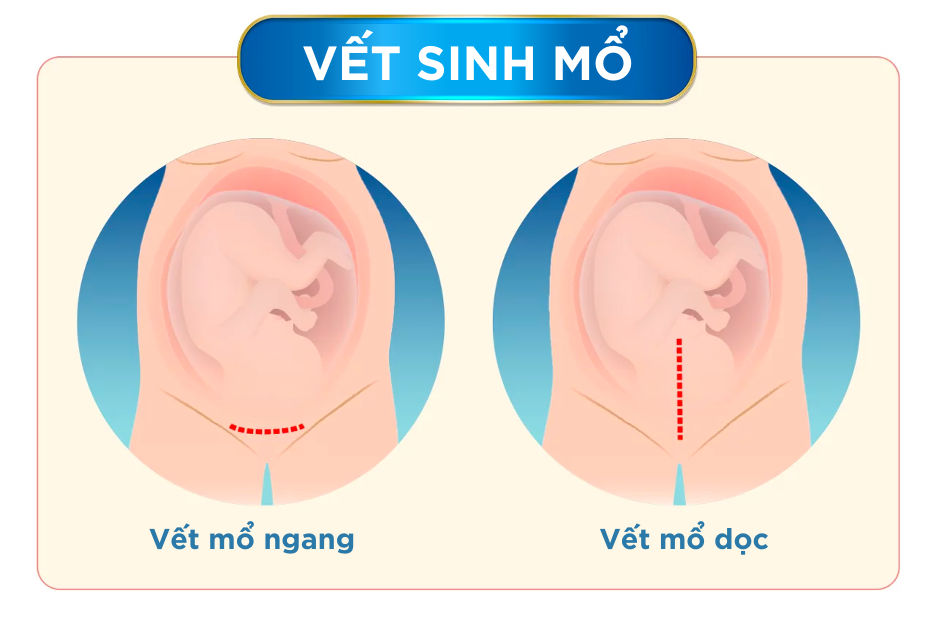 Vết mổ ngang - 1