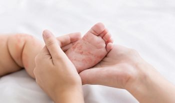 Measles virus. Mother holding tiny baby foot with red rash, closeup