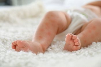 Little child with red rash on bed, closeup. Baby allergies