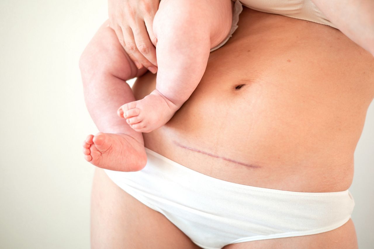 Mom's abdomen after cesarean section. Scar seam. A young mother holds the baby in her arms. Real motherhood. Lifestyle. High quality photo