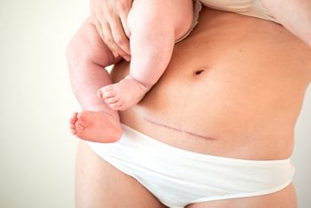Mom's abdomen after cesarean section. Scar seam. A young mother holds the baby in her arms. Real motherhood. Lifestyle. High quality photo