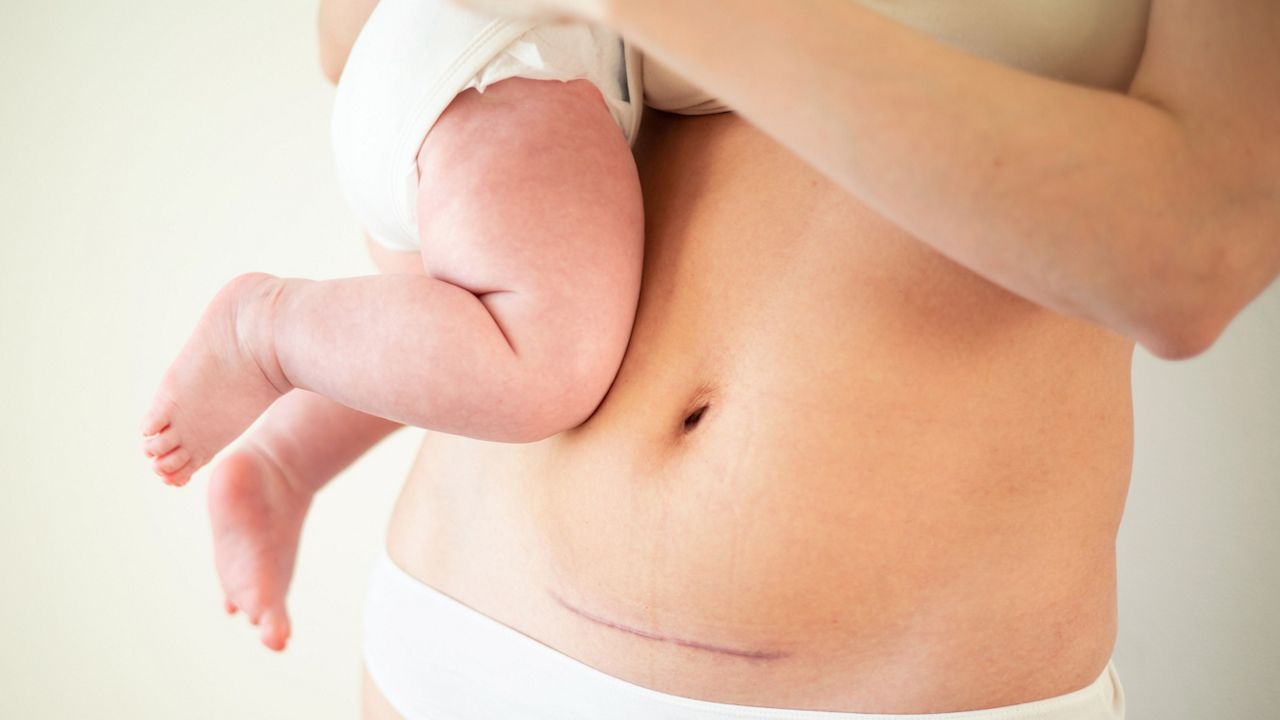 Caesarean Scars – Management of C-Section scars