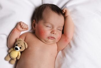 Cute little baby with allergic redness sleeping on soft bed, top view