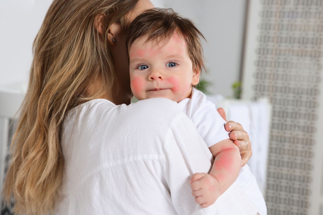 Mother hugging her cute daughter at home. Little baby with allergic redness