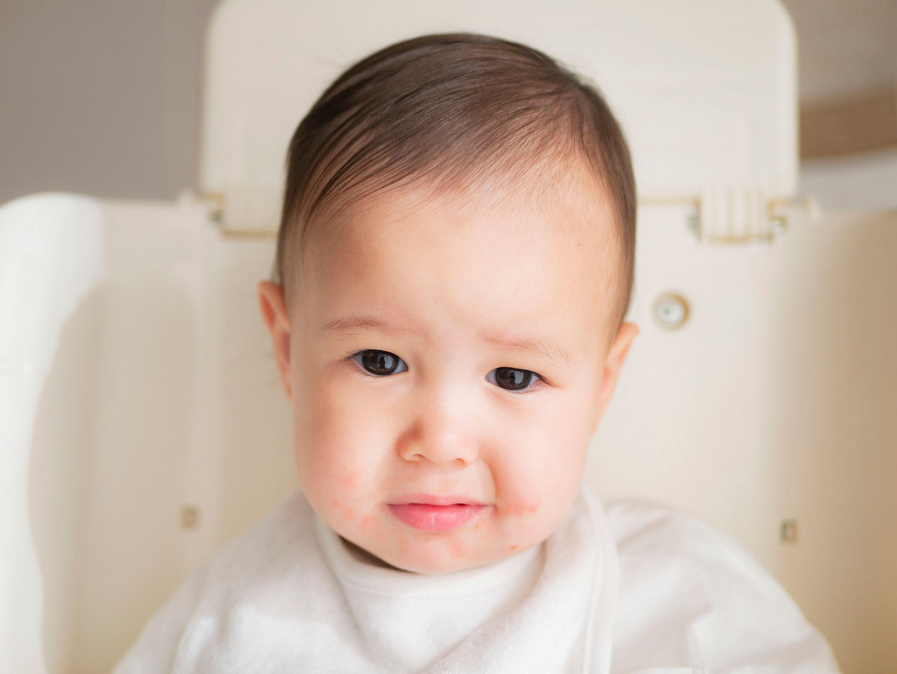 A baby  who has eczema around his mouth