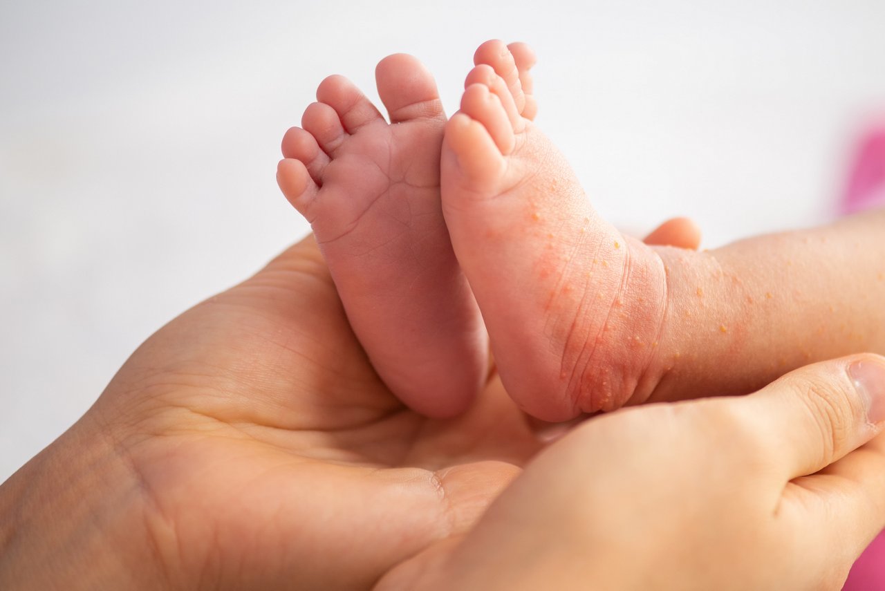 Infant legs with red dry skin. Suffering from allergy of milk formula or other food. Closeup.shot