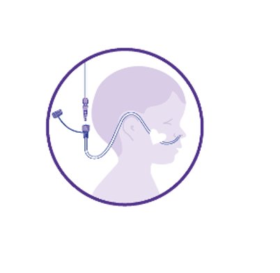 DACH_MKIB_Grafiken_Nasensonde