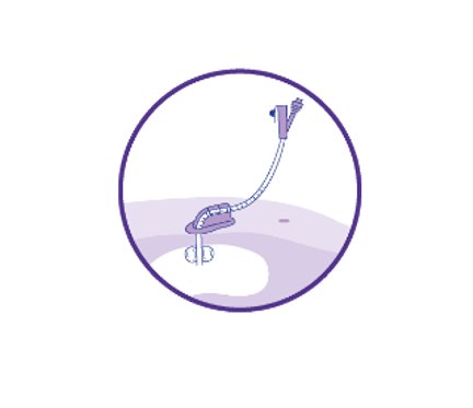 DACH_MKIB_Grafiken_PEG_Sonde