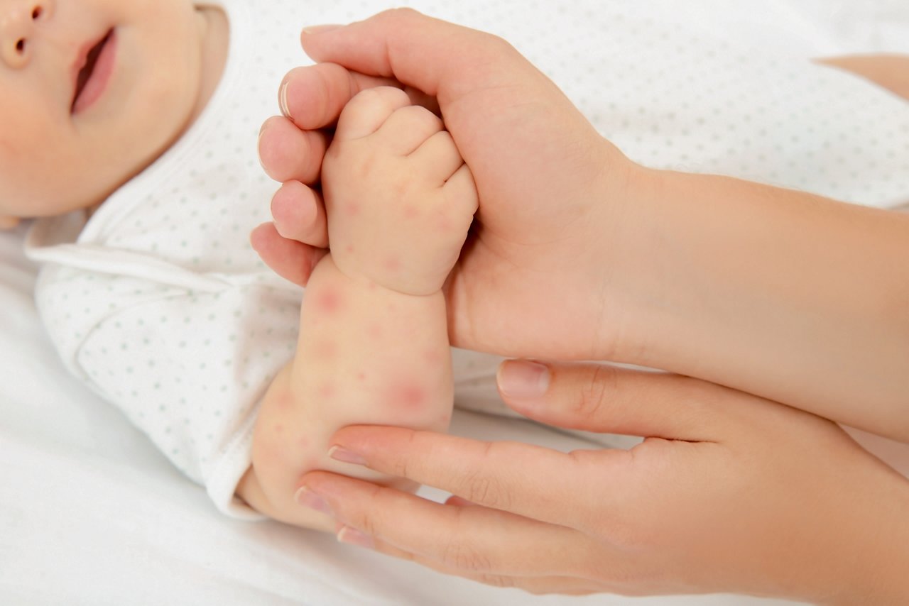 Mutter begutachtet Ausschlag am Arm ihres Kleinkindes