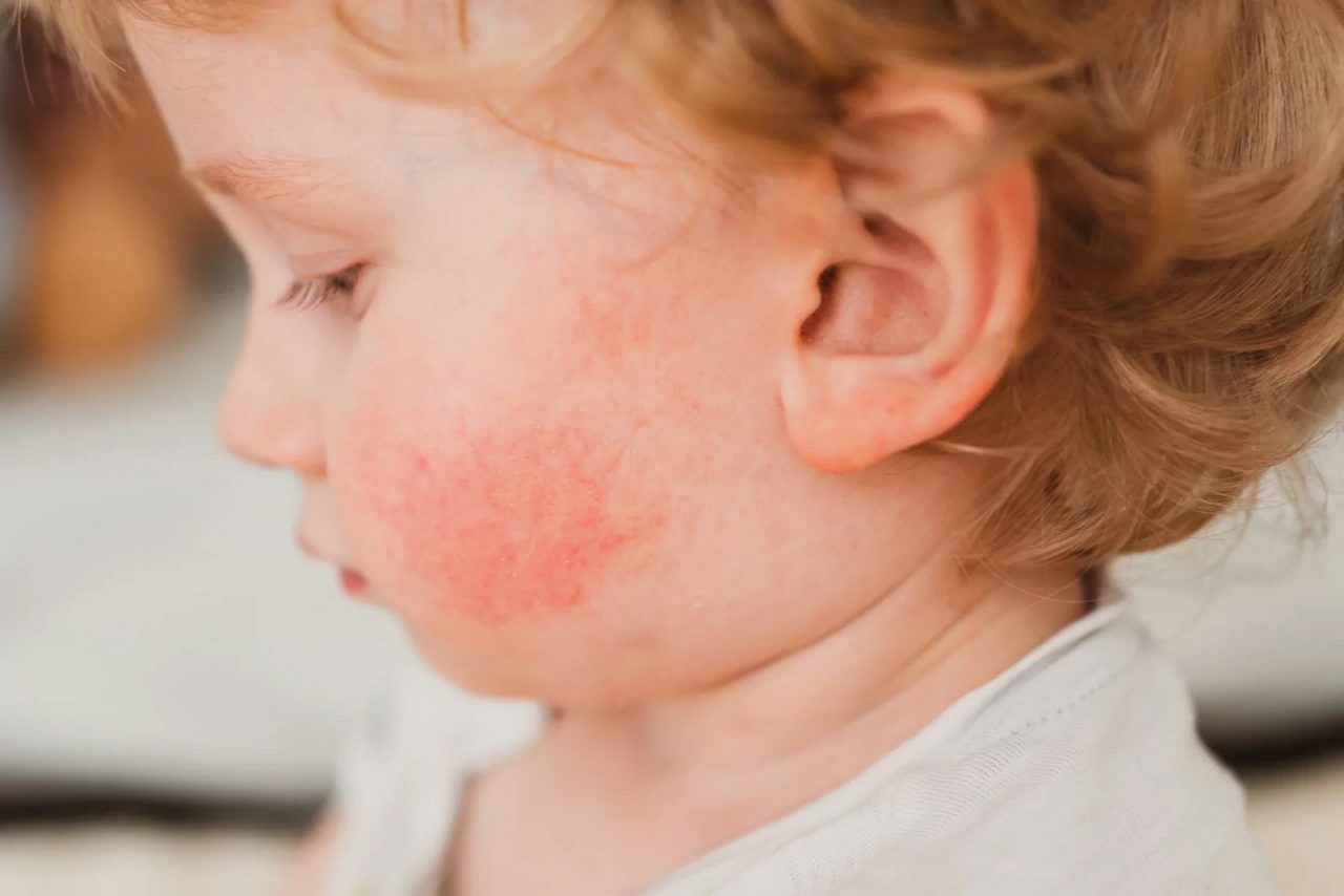 Atopische Dermatitis Gesicht