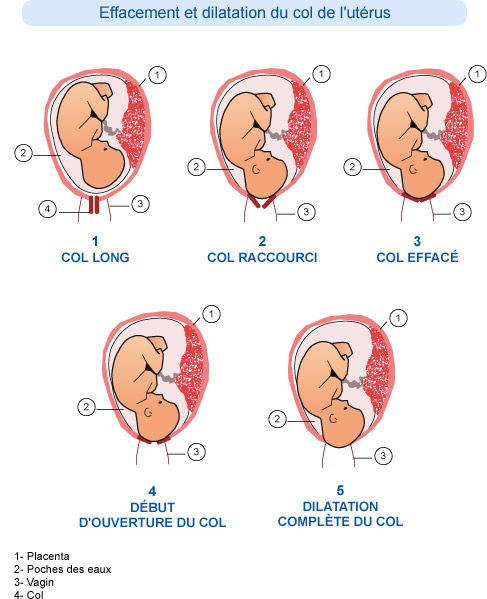 Illustration illustrant les etapes progressives de l effacement et de la dilatation du col de l uterus pendant l accouchement. L image comprend des diagrammes etiquetes montrant la position du foetus, du placenta, du sac amniotique et du vagin. Le texte francais fournit des descriptions pour chaque etape, y compris 'Col long', 'Col raccourci' et 'Dilatation complete du col.' Les etiquettes numeriques (1-4) correspondent aux parties anatomiques.