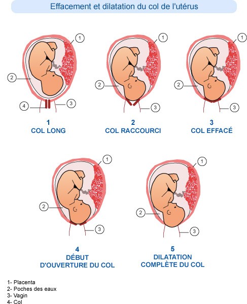 Illustration illustrant les etapes progressives de l effacement et de la dilatation du col de l uterus pendant l accouchement. L image comprend des diagrammes etiquetes montrant la position du foetus, du placenta, du sac amniotique et du vagin. Le texte francais fournit des descriptions pour chaque etape, y compris 'Col long', 'Col raccourci' et 'Dilatation complete du col.' Les etiquettes numeriques (1-4) correspondent aux parties anatomiques.