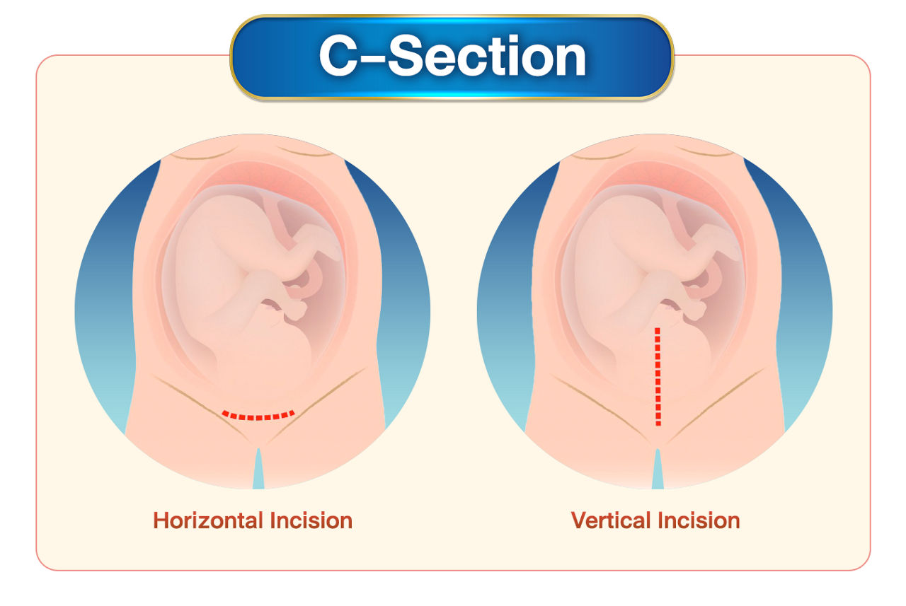 การผ่าคลอดแนวขวาง และ การผ่าคลอดแนวตั้ง