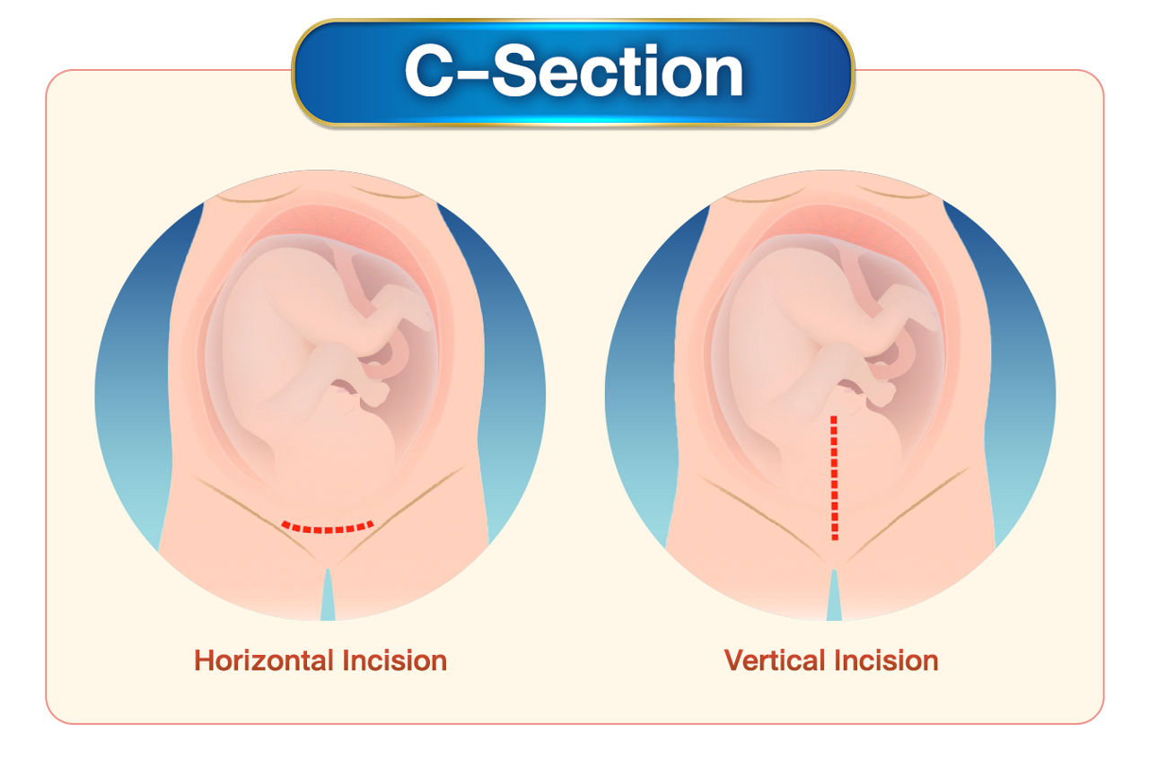  C-section care for caesarean wound
