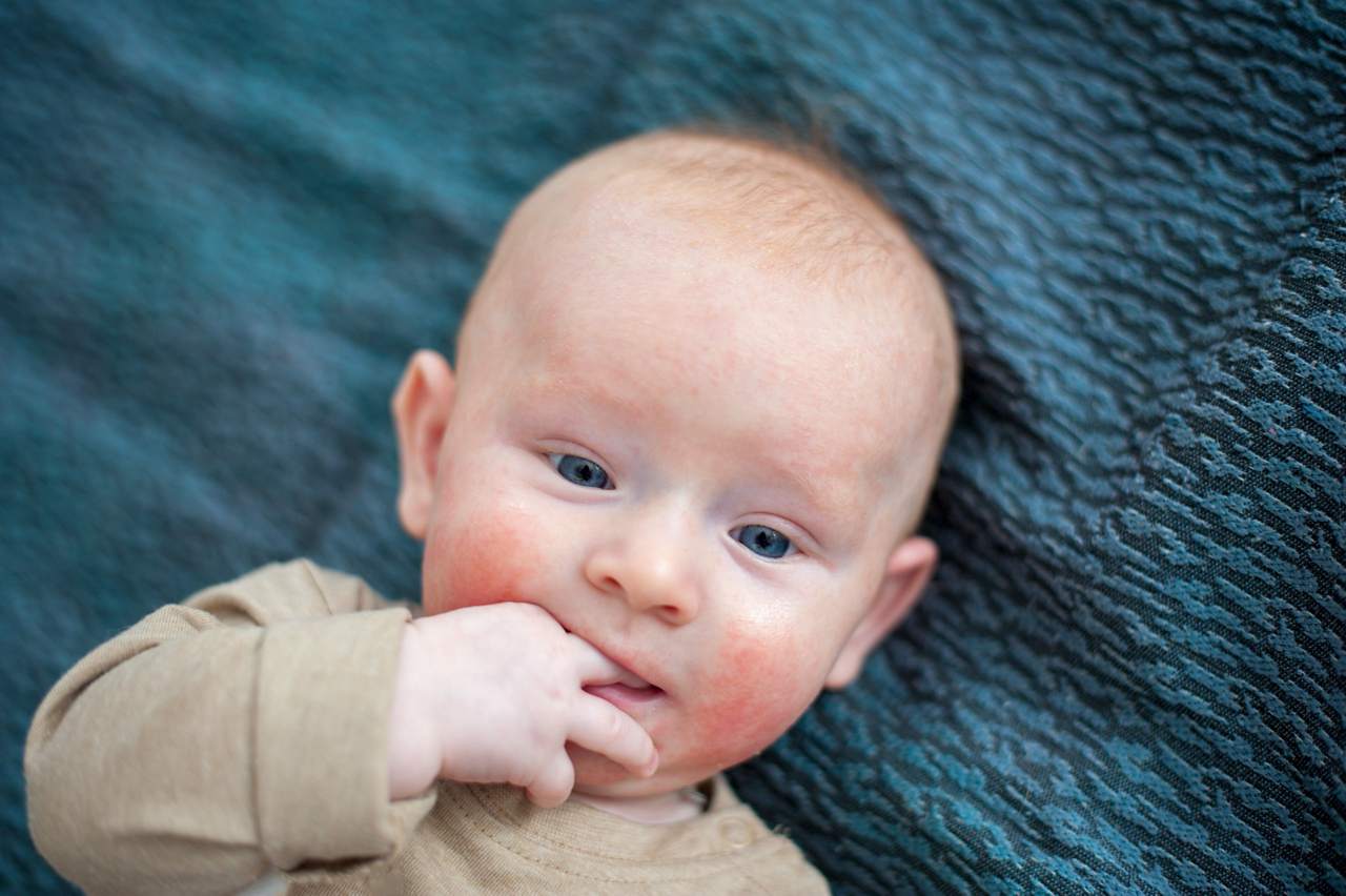 allergy-baby-close-up-shot