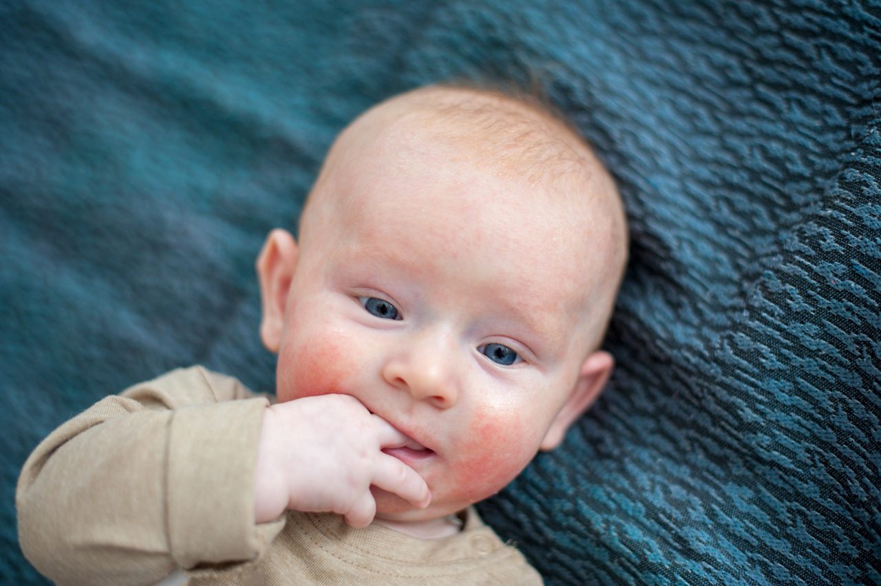 allergy-baby-close-up-shot