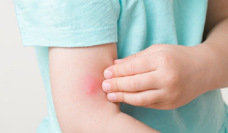 Toddler girl fingers itching red bite of mosquito on arm skin. Closeup.