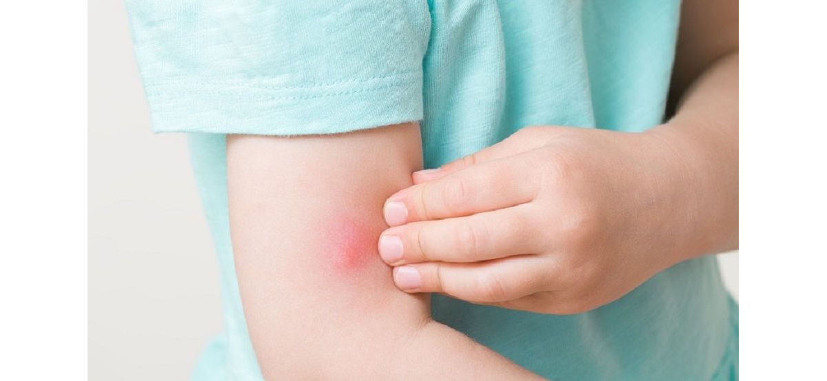 Toddler girl fingers itching red bite of mosquito on arm skin. Closeup.