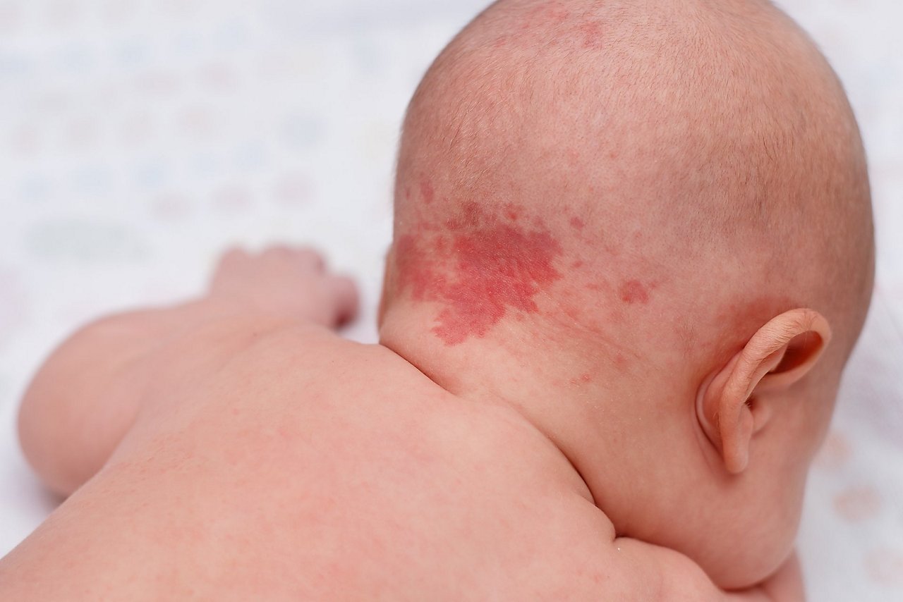 Baby mit Storchenbiss im Nacken