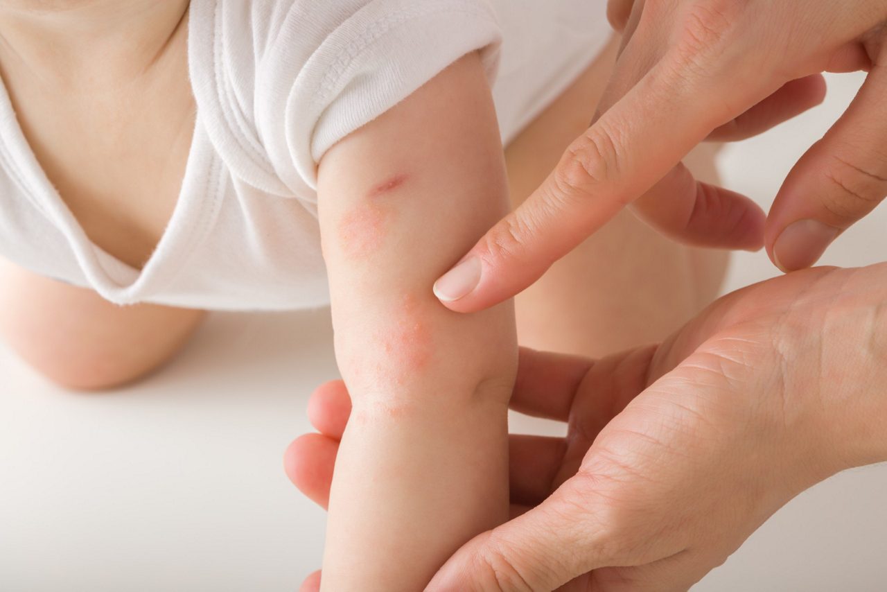 Bébé avec éruption cutanée sur le bras