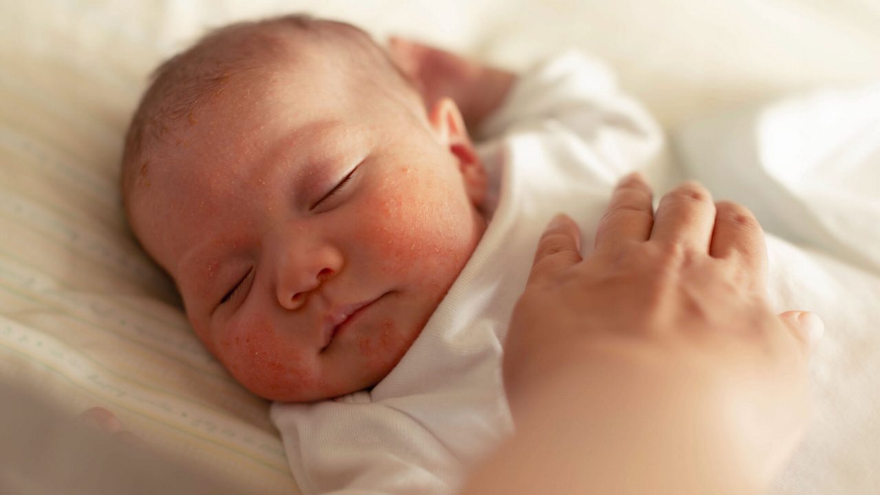 Hitzepickel beim Baby: Erkennen, vorbeugen und behandeln