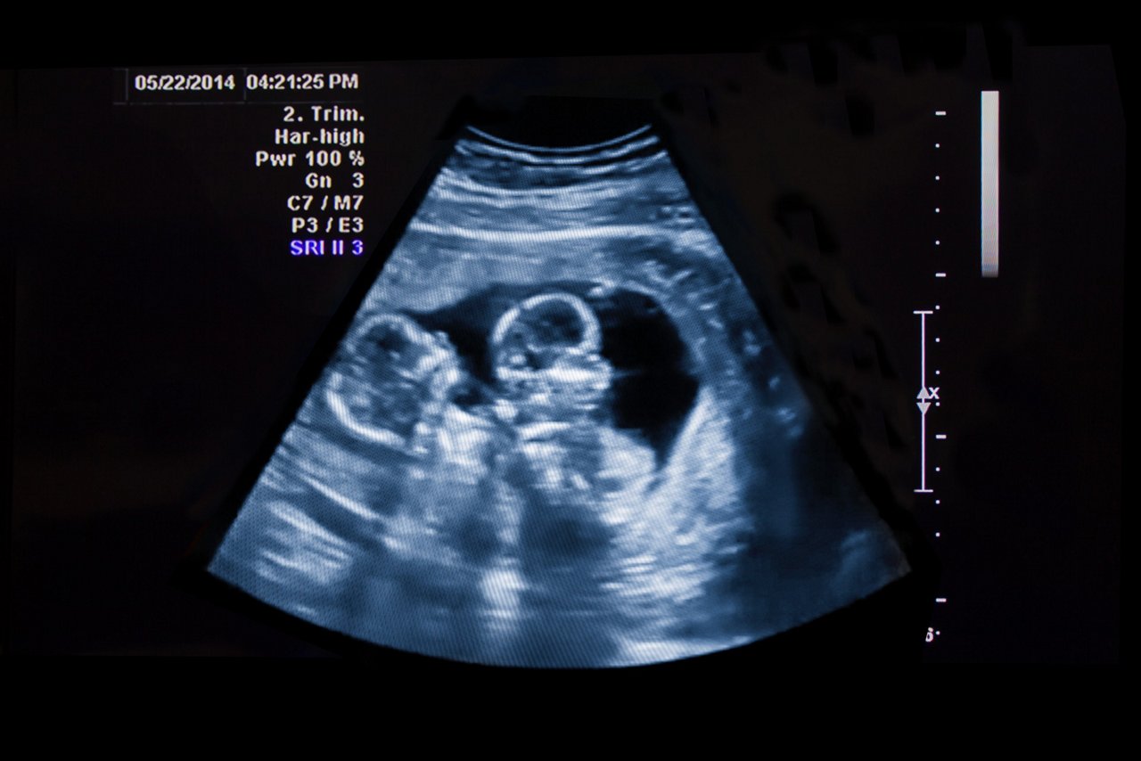 Ultraschallbild von Zwillingen im 2. Trimester