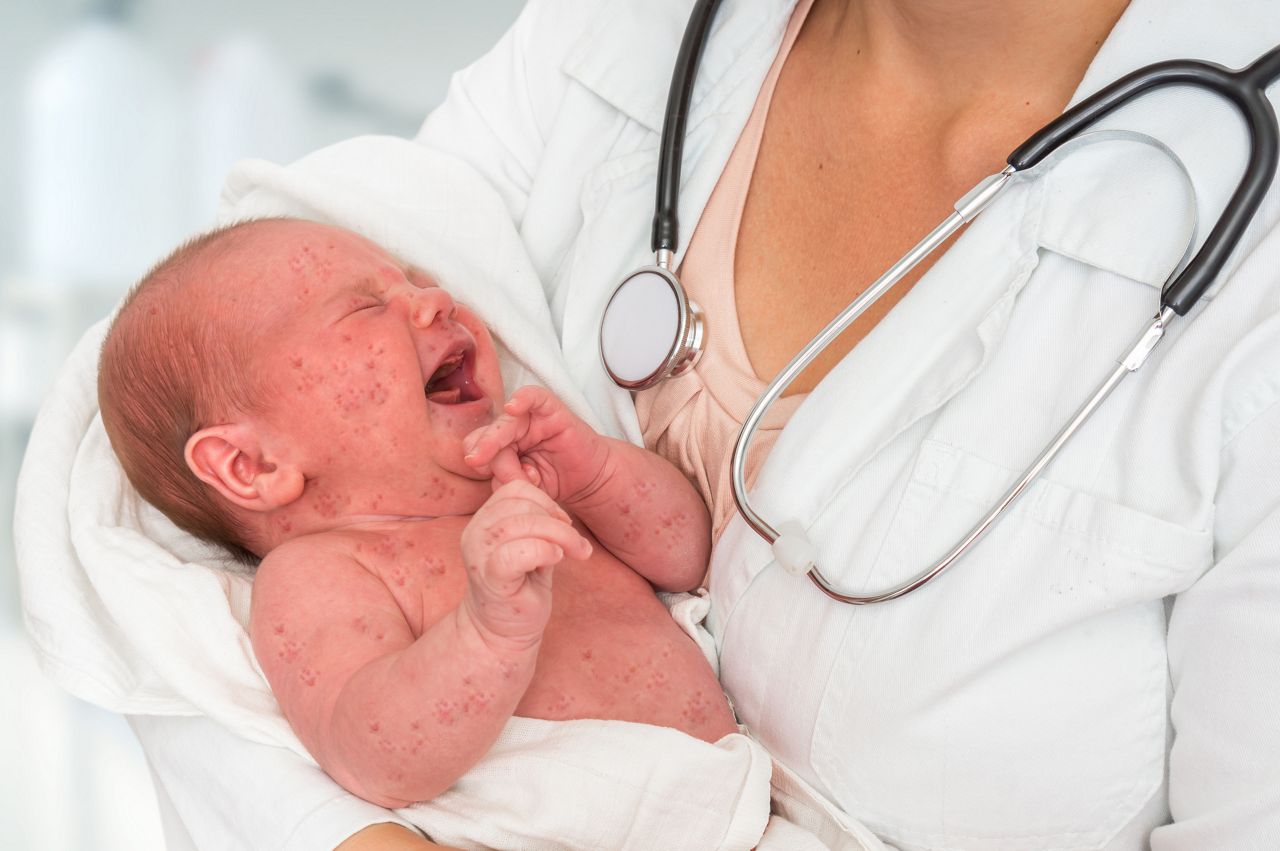 Doctor with stethoscope holding a newborn baby which is sick rubella or measles