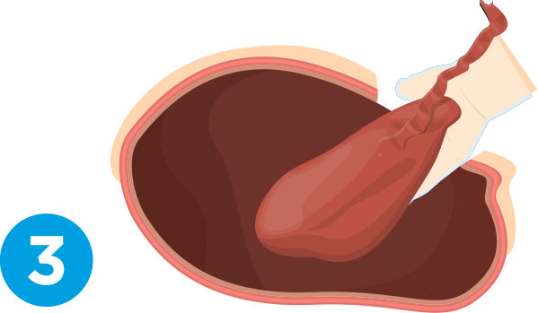 c-section-process-step-3