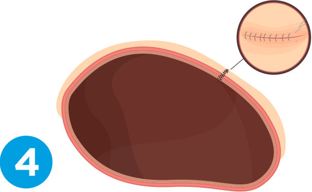 c-section-process-step-4