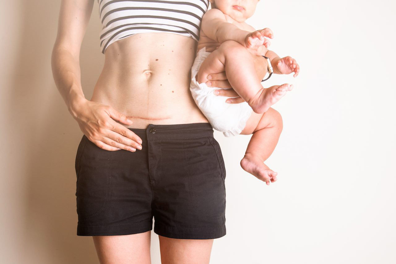 Cách chăm sóc vết mổ sau sinh nhanh lành tại nhà
