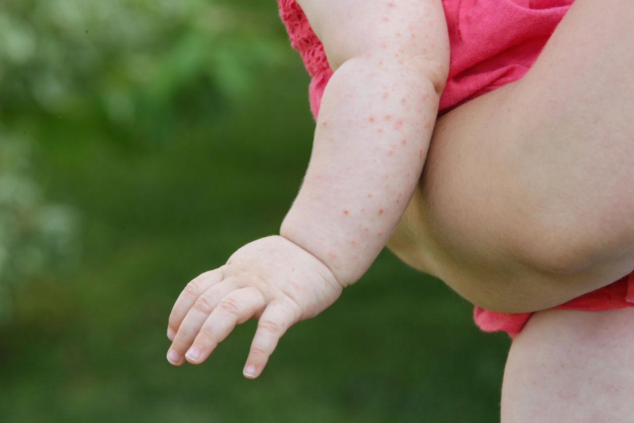 Baby rash caused by fever, insect bite, skin allergy or heat reaction