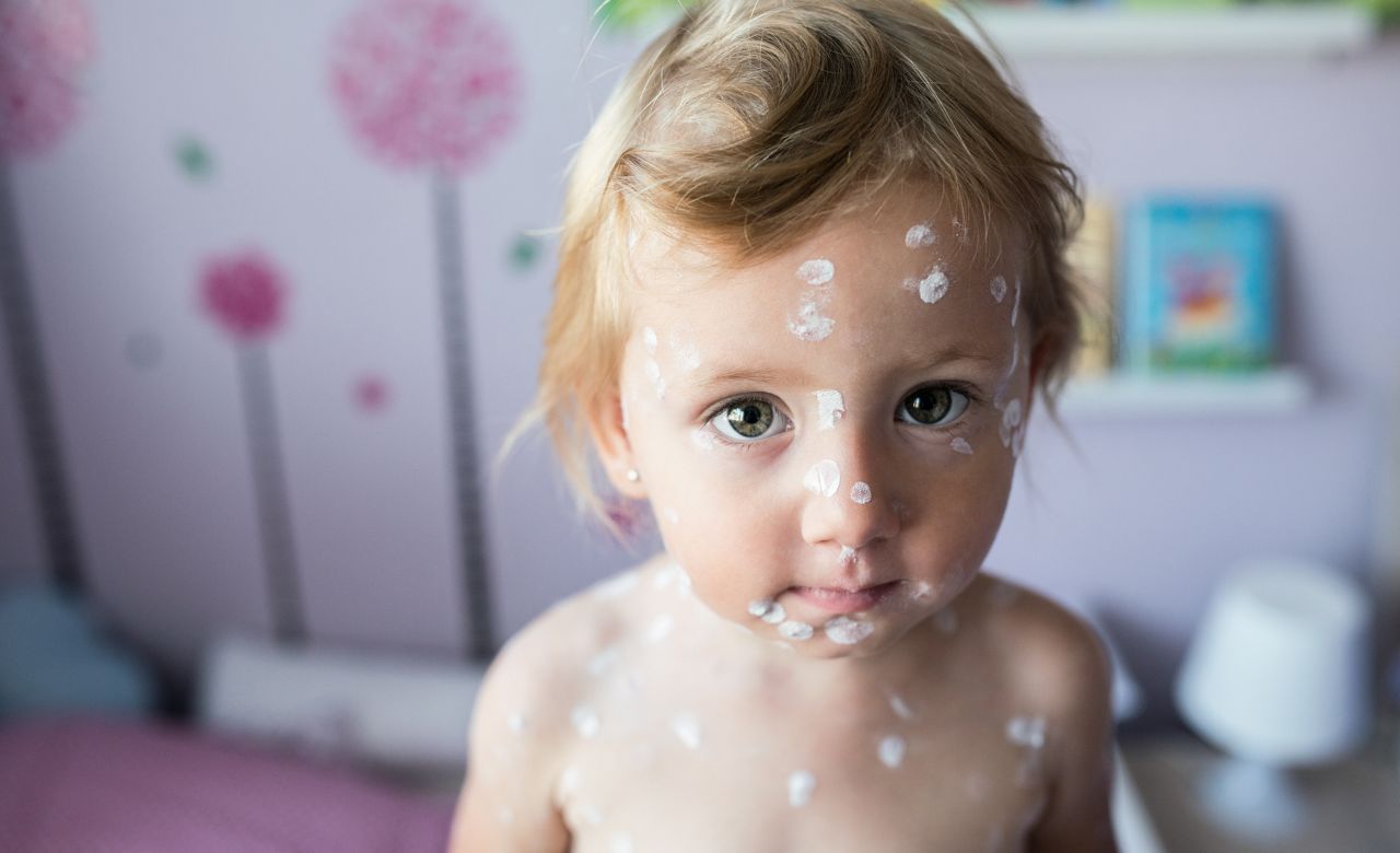 Little two year old girl at home sick with chickenpox, white antiseptic cream applied to the rash