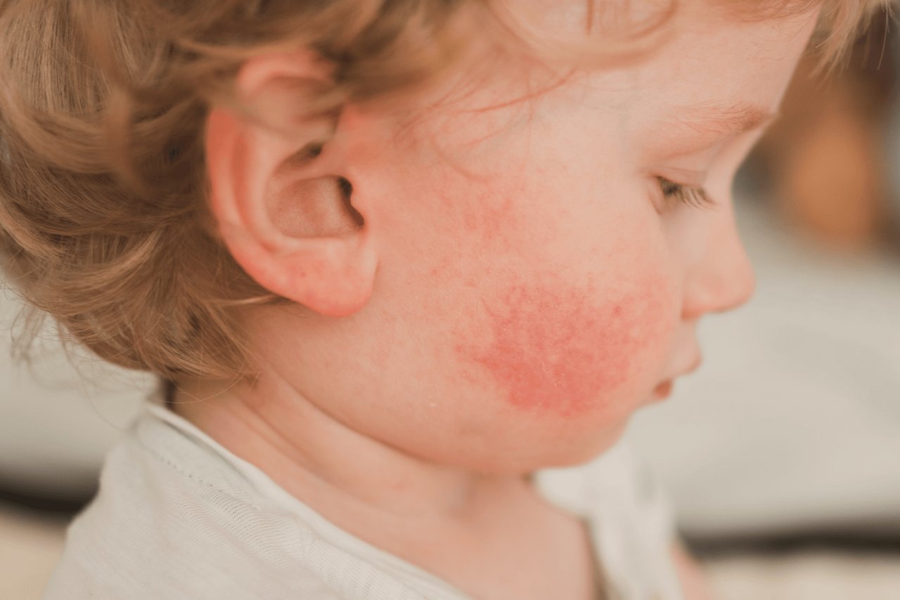 Kind mit Ausschlag im Gesicht