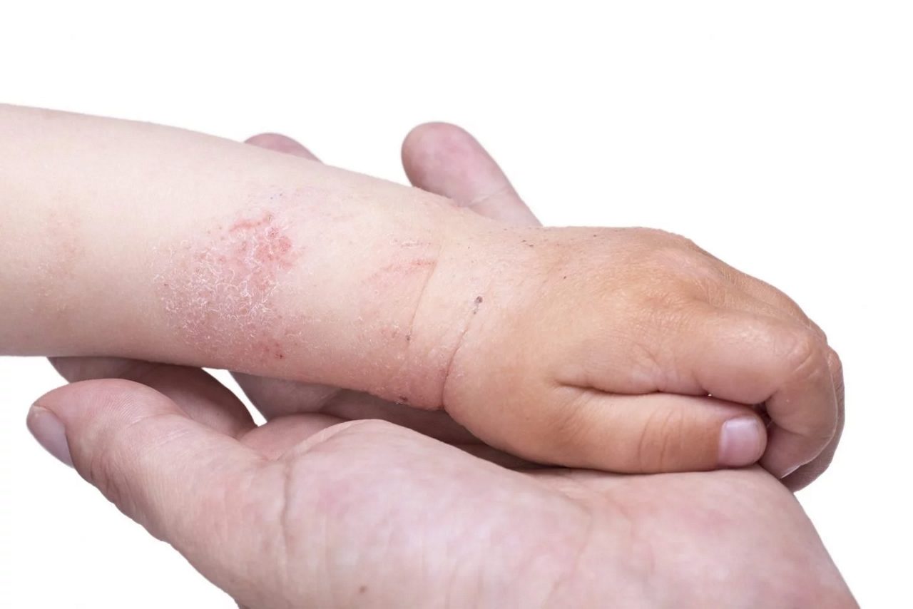Hand eines Kindes mit Hautproblemen